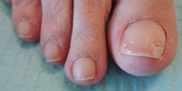 Проблемы с ногтями при хронической интоксикации формальдегидом