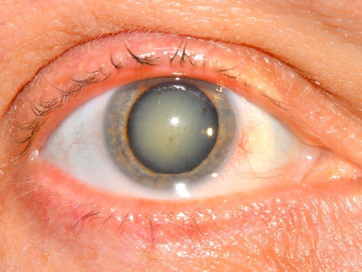 Помутнение глазного хрусталика