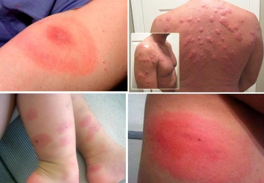 Аллергия на теле от укусов